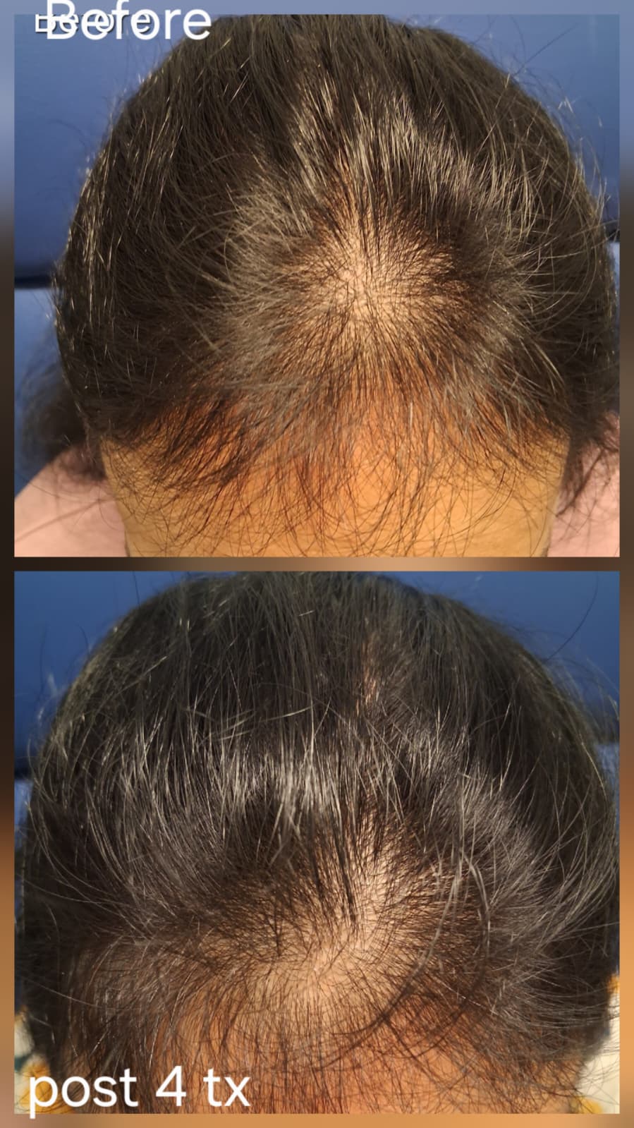 Hair restoration result
